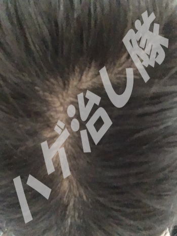 花蘭咲を使用前の頭皮